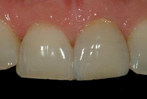審美治療例治療後前歯Ｂ