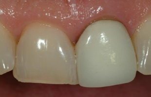 審美治療例治療前前歯Ｂ